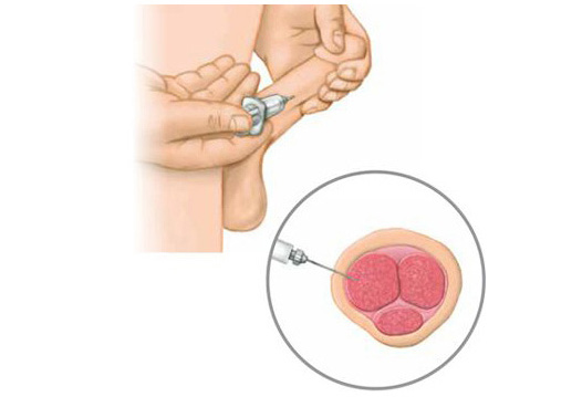 Saline Penis Injection